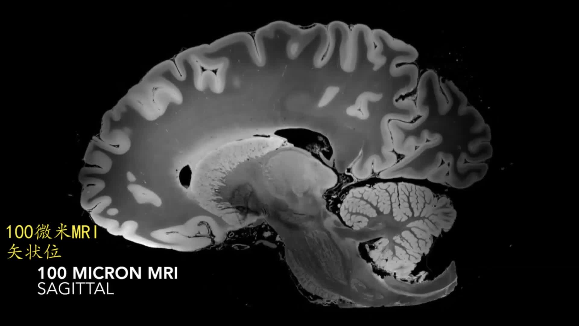 磁共振扩散加权成像对不同时期脑梗死的诊断意义